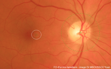 Fundus av en lamellær foramen