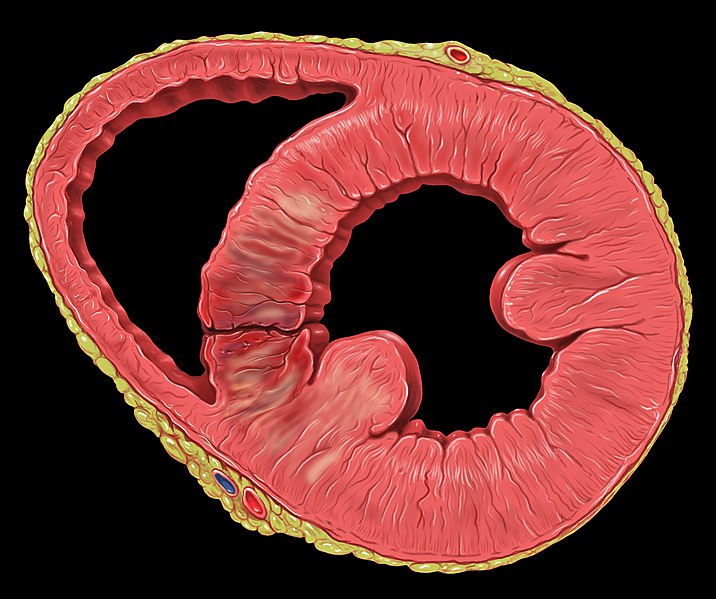 File:Heart post infarct vsd.jpg