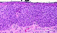 High-Grade Squamous Intraepithelial Lesion of the Cervix (311128961).jpg