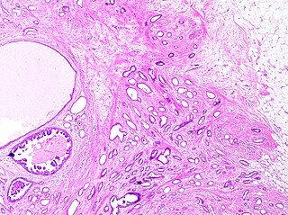 <span class="mw-page-title-main">Tubular carcinoma</span> Type of breast cancer