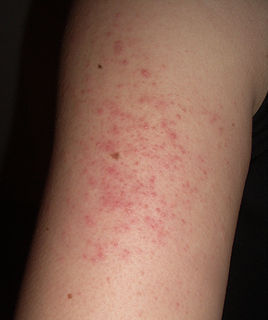 Keratosis