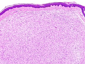 Neurofibroma (1).jpg