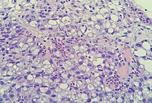 Poorly cohesive gastric carcioma (signet-ring cell type) x400, H&E stain