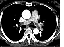 comment guerir embolie pulmonaire