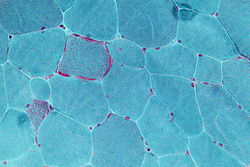 صورة مجهرية تظهر ألياف حمراء ممزقة، وهي ظاهرة مُشاهَدة في أنواع مختلفة من أمراض الميتكوندريا