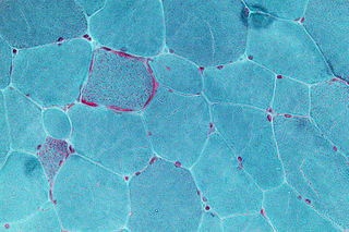 <span class="mw-page-title-main">Muscle biopsy</span> Procedure in which a piece of muscle tissue is removed from an organism and examined microscopically