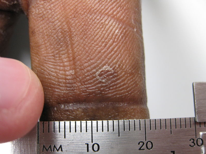 File:Rim of scale on plantar surface of thumb.jpg