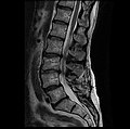 MRI lumbar spine with degeneration, post-hemilaminectomy L4-5 (sagittal T2 FRFSE)