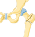 Thigh bone fracture - Fracture of femur