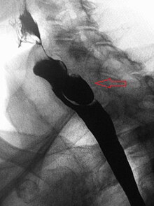 Lateral X-ray of a Zenker's diverticulum Zenker22015Lateral.JPG