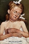 A girl in the London Asylum suffering from chronic pellagra. Wellcome V0022633.jpg