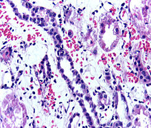 Presence of lymphocytes within the tubular epithelium, attesting to acute cellular rejection of a renal graft. Biopsy sample. Acute cellular rejection, renal graft biopsy.jpg