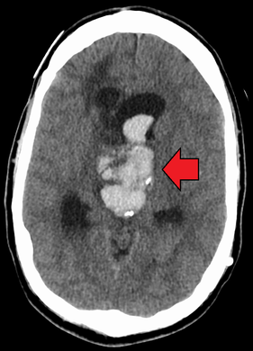 An acute bleed into a long-standing cystic mass within the brain. Arrow points to bleeding and mass.