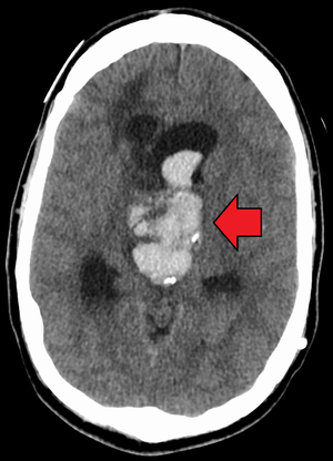 Intracranial Hemorrhage