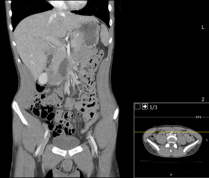 CT of a normal abdomen and pelvis, coronal plane 49.png