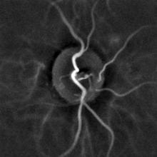 hipertónia retinopathia