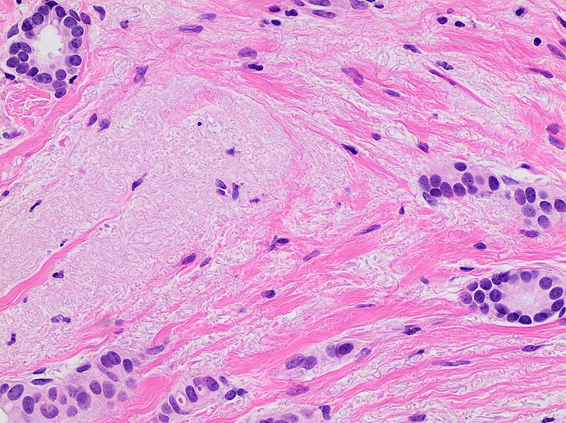 File:Histopathology of invasive ductal carcinoma with partial response to chemotherapy.jpg