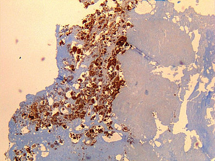 Immunohistochemical detection of C. burnetii in resected cardiac valve of a 60-year-old man with Q fever endocarditis, Cayenne, French Guiana, monoclonal antibody against C. burnetii and hematoxylin were used for staining: Original magnification ×50