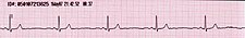 EKG záznam