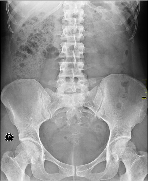 File:Medical X-Ray imaging RGF06 nevit.jpg