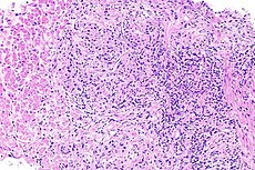 Prostate carcinoma with inflammation -- intermed mag.jpg