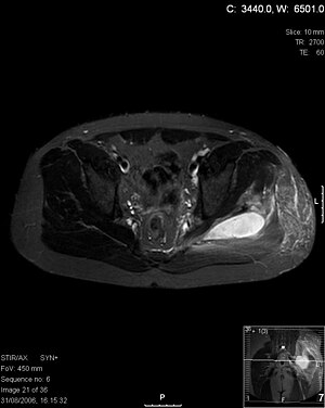 Pyomyositis MRI.jpg