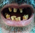 Thumbnail for Tooth discoloration