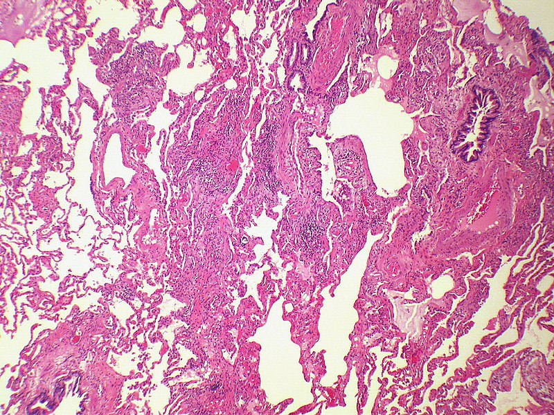 File:UIP (Usual interstitial pneumonia) (4744511012).jpg