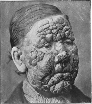 <span class="mw-page-title-main">Leprosy in Louisiana</span>