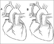 Schemat operacji Blalock-Taussig – połączenie prawej tętnicy podobojczykowej z prawą tętnicą płucną. A – pierwotne bezpośrednie połączenie. B – połączenie zmodyfikowane z użyciem protezy naczyniowej.