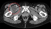 Thumbnail for Iliopectineal bursa