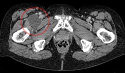 Bursa iliopectinea rechts vergroessert (بورسیت) - CT محوری 001 - Annotation.jpg