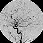 Vorschaubild für Digitale Subtraktionsangiographie