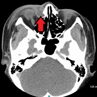 Dacryocystitis Medical condition