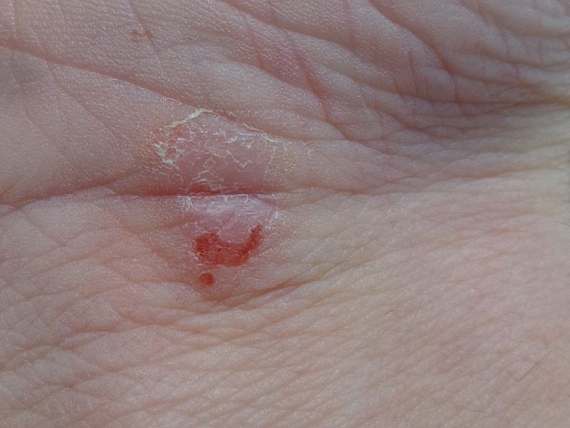 File:Dermatitis atopica 01.JPG