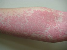 Hives allergic reaction on arm EMminor2010.JPG