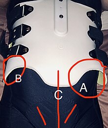 Full rigid TLSO back brace - fitted to female adolescent patient showing issues with the patient fitting around hips and pelvic areas Full shell back brace - fitted to female adolescent.jpg