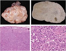 Gross pathology and histopathology of signet ring cell carcinoma metastasis to the ovary.jpg