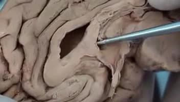 ملف:Human Brain Circumventricular Organs 4 - SubFornical Organ - Sanjoy Sanyal.webm