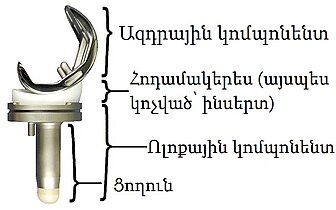 Ծնկան Հոդի Էնդոպրոթեզավորում