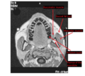 MRI showing masseter muscle and neighbors.png