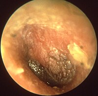 Acute otitis media