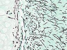 Pulmonary aspergillosis (1) invasive type.jpg