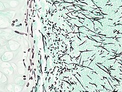 Pulmonary aspergillosis (1) invasive type.jpg