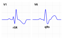 Right bundle branch block ECG characteristics.svg