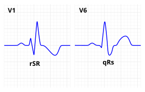 Sağ dal bloğu EKG özellikleri.svg