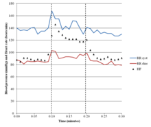 Postural orthostatic tachycardia syndrome (POTS) results in a sustained  increase in heart rate of at least 30 beats per minute in adults