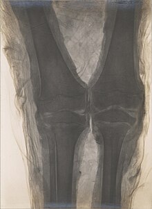 The first X-ray of a mummified Egyptian showing the knees of a child mummy in the collection of Naturmuseum Senckenberg Walter Koenig x-ray of AS 18 knees.jpg