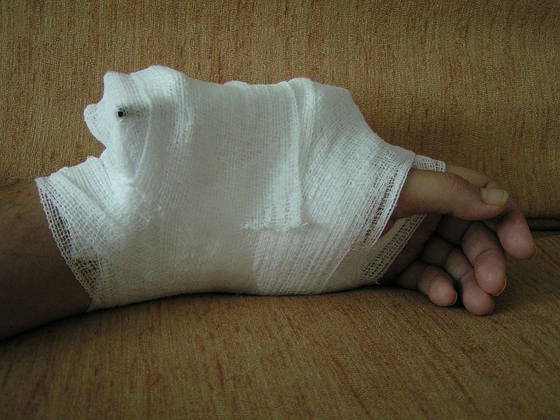 File:Wrist fracture.JPG