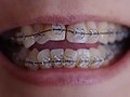 2015-03-10 teeth wearing dental braces.jpg